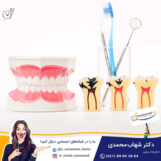 ایمپلنت دندانی جایگزین دندانهای قوس کامل یک فک - کلینیک دندانپزشکی دکتر شهاب محمدی